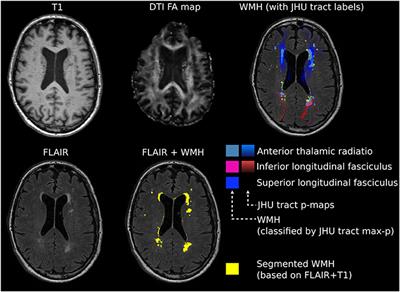 White Matter Hyperintensities Are Associated With Severity of Essential Tremor in the Elderly